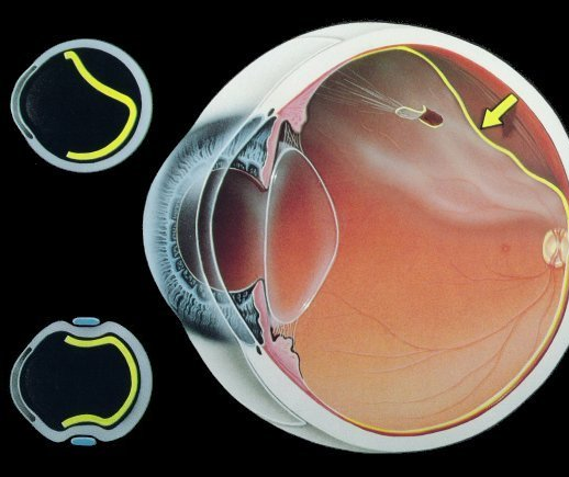 desprendimiento de retina